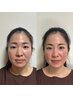 【頭から足までフルコース】ルート鬼美容鍼+全身鍼施術 120分 ¥18000