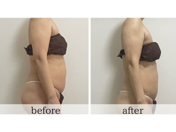 リュクス(LUXE)/50代/ぽっこりお腹解消