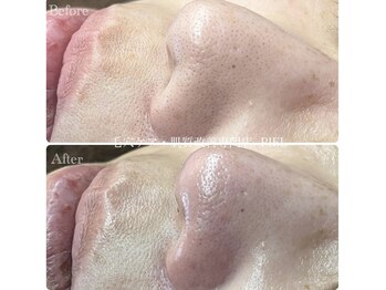 ピエル 北千住店(PIEL)/毛穴の黒ずみは綺麗になります