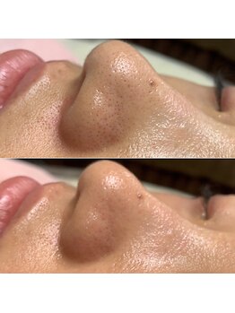 シンディー(CINDY)/毛穴洗浄