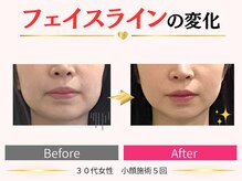 タイナ(taina)/30代女性/小顔施術6回