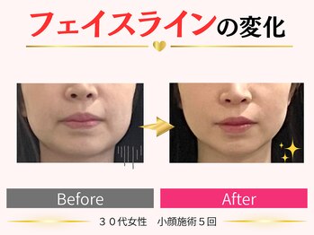 タイナ(taina)/30代女性/小顔施術6回