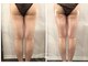 美極 銀座店の写真/好きな箇所選択可能で気になるパーツに集中！脂肪撃退し理想なボディーに近づく♪