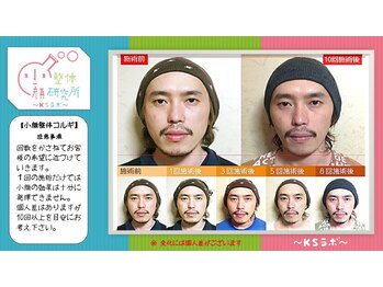 小顔整体研究所 KSラボ 金沢長坂店/比較写真