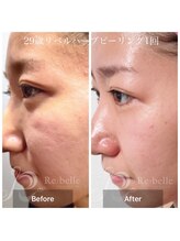 ブールドネージュ(Boule de Neige)/肌質改善リベルハーブピーリング