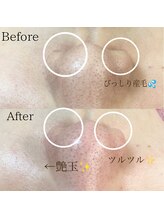 ラ フルール(La Fleur)/小鼻クリーンケア