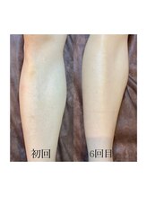 カウピリ(kaupili)/【脱毛】ビフォーアフター