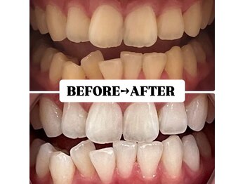 ホワイトニングサロン 豊中/Before&After美白ホワイトニング