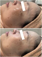 リッツ 草加店(Ritz)/【Before/After】シミ改善