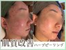 【ニキビケア/肌荒れ】根本から改善！肌質改善ハーブピーリング