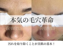 フェミナ(femna)の雰囲気（毛穴の黒ずみ・角栓・皮脂詰まりにお悩みの方におすすめ★）