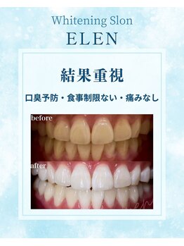 エレン 高槻店(ELEN)/自信のつく白い歯へ