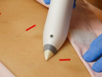 トーリ 代官山(taulli)/鍼とデジタル温灸で相乗効果