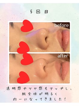 リリアン(lirien)/毛穴/毛穴ケア/毛穴洗浄/駒込