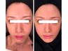 【4回目以降】フェイスラインが引き締まる幹細胞Litフェイシャル