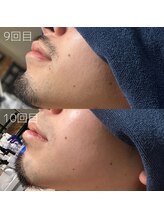 カナウ(KANAU)/ヒゲ脱毛（20代前半男性）