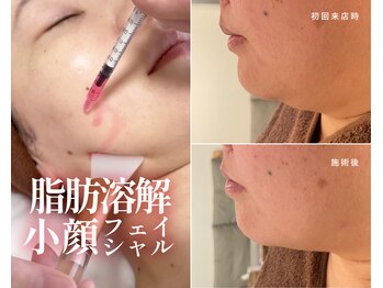 シュシュ(Chouchou)の写真/ホウレイ線・たるみが気になる方へ♪進化版レモンボトルでフェイスラインを引き上げ、弾むハリ肌＆小顔へ！