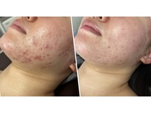 ミュアン(La Mueien)/長年悩みのニキビにアプローチ