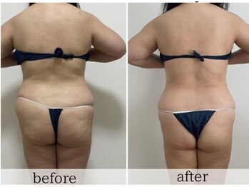 リュクス(LUXE)/50代/背中痩せ&メリハリbody