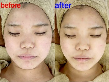 ラグーン(Lagoon)/小顔矯正＋コルギ