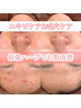 ラエッセ(LAESSE)/ハーブピーリング♪