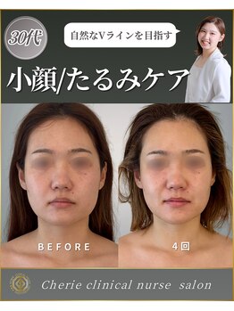 シェリー(Cherie)/30代のたるみ・小顔ケア