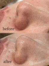 ベリス(BELLIS)/気になる毛穴も押し出さずにケア