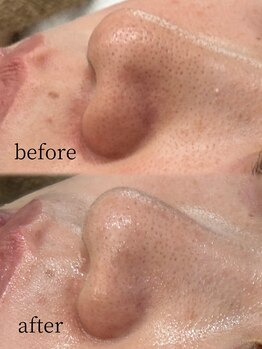 ベリス(BELLIS)/気になる毛穴も押し出さずにケア