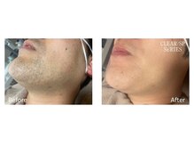 スタンド(STAND)/髭脱毛