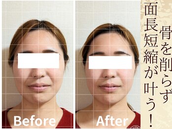 スウ(suu.)/Before-After【30代】1回