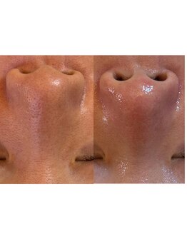 フルリール(Fleurir)の写真/当店の毛穴エクストラクションは、変化を感じやすい！詰まりに詰まった頑固な毛穴汚れもゴッソリ除去◎