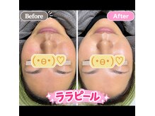 ココスタイルビューティー(COCOSTYLE beauty)の雰囲気（ララピールは毛穴レス、美白、透明感アップ）