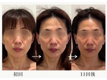 エレミュー 烏丸(Elemue.)の雰囲気（食いしばりからの顔悩みしっかり改善コース）