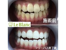 ルブラン 奈良店(Le Blanc)/日頃の心掛けで歯を健康に保つ！