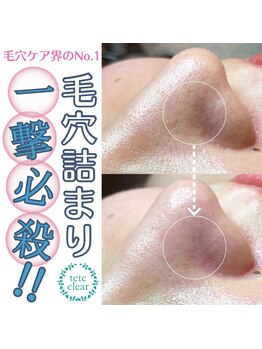 エミール/毛穴エクストラクション(9)