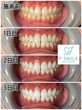 ホワイトベース(White Base)/お客様の施術後！！