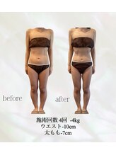 カリス(charis)/施術回数４回