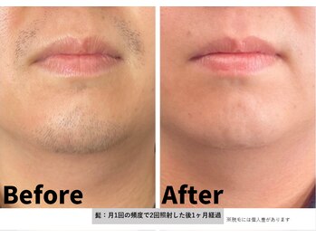 シェール(Cher)/ヒゲ脱毛