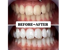 ホワイトニングサロン 豊中/Before&After美白ホワイトニング
