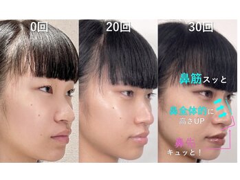 ラプリアンジュ 鹿児島天文館店(Raplit ange)/隆鼻+輪郭矯正40分30回