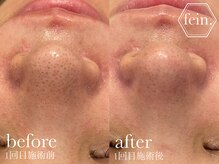 フェイン 青山店(fein.)/くすみ改善・剥離なしピーリング