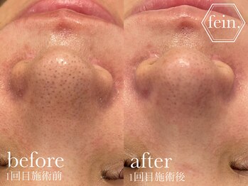 フェイン 青山店(fein.)/くすみ改善・剥離なしピーリング