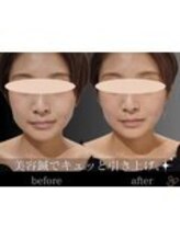 チョコバリ 錦糸町店(chocobari)/小顔×リフトアップ(美容鍼)20代