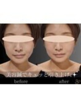 チョコバリ 錦糸町店(chocobari)/小顔×リフトアップ(美容鍼)20代