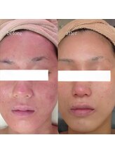 アーネスト 大阪心斎橋店(EARNEST)/水分爆弾補給【 PHAピール 】