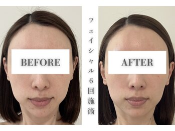 リアレント 高槻店(Lialent)/インディバフェイシャル・6回