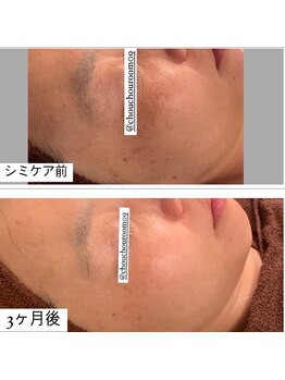 ミニョン(Mignon)/スタッフ周のシミ改善写真