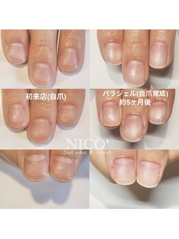 ニコプラス(NICO+)/自爪育成中