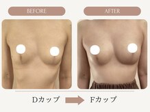 ウェルバスト(Well Bust)/【バストアップ例】D→Fカップ