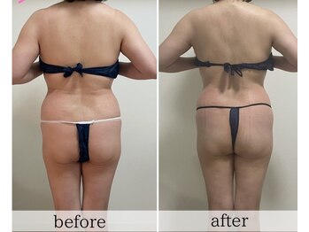 リュクス(LUXE)/50代/ハミ肉スッキリ!